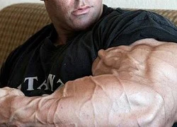 Bắp tay biến dạng kinh hoàng do lạm dụng steroid