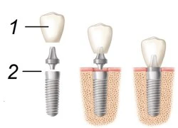 Cách chăm sóc trụ răng nhân tạo