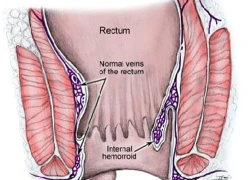 Cách chữa bệnh trĩ tận gốc để ngừa tái phát