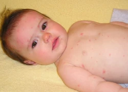 Cách phân biệt thủy đậu, quai bị và rubella