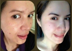 Công nghệ Laser làm trắng da siêu nhanh khuyến mãi 60%