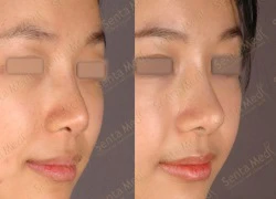 Phẫu thuật thẩm mỹ bằng Laser lên ngôi 2014