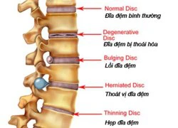 Thoái hóa cột sống - Làm thế nào để khỏi bệnh?