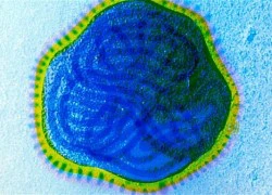 Trị ung thư bằng virus sởi