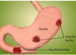 6 điều quan trọng về viêm loét dạ dày ai cũng cần biết