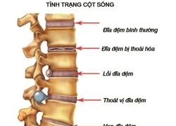 Bệnh gai cột sống và biến chứng