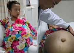 Cô bé 12 tuổi đáng thương mang khối u to bằng quả dưa hấu trong bụng