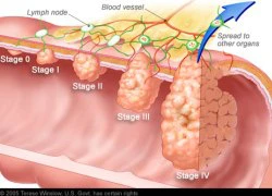 Những điều cần biết để phòng bệnh ung thư gan