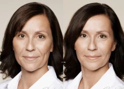 Trẻ lại nhờ botox, restylane