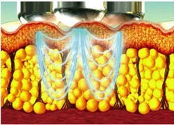 Tư vấn giảm cân nhanh và an toàn sức khỏe