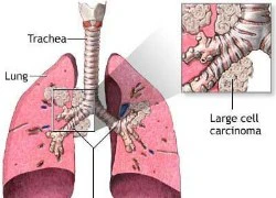 Có 10 dấu hiệu sau, có thể ung thư phổi đã &#8216;hỏi thăm&#8217; bạn