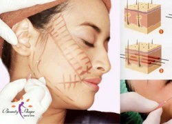 Giải pháp xóa nhăn tối ưu không cần chích botox.