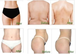 Hủy mỡ 1 lần duy nhất không phẫu thuật công nghệ Coolshaping khuyến mại đặc biệt 90%