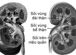 Bệnh sỏi thận - Ngăn ngừa tái phát trong điều trị