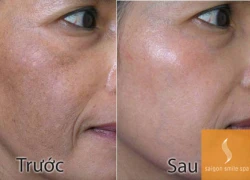 3 lưu ý khi trị nám bằng laser