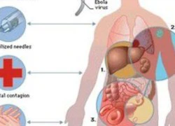 Bộ Y tế chính thức công bố phác đồ điều trị bệnh do vi rút Ebola