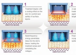 Cơ hội điều trị trực tiếp với chuyên gia Thermage