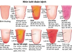 Đoán sức khỏe qua lưỡi của bạn