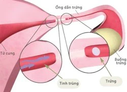 Phải làm gì khi vòi trứng không thông?