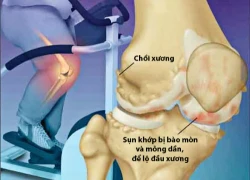 Phụ nữ béo phì có nguy cơ thoái hóa khớp gối cao gấp 6 lần