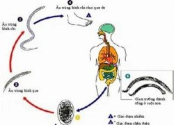 Từ 20-50% người Việt có thể bị nhiễm giun