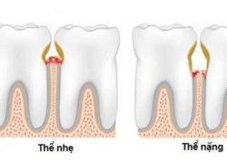 Những biến chứng nguy hiểm của bệnh viêm lợi