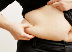 Velashape &#8211; bí quyết giảm cân và xóa rạn da.