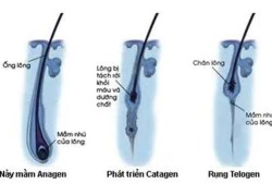 Công nghệ triệt lông 6G hiệu quả tới 95%