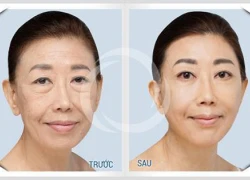 Khuyến mại 70% Thermage phiên bản mới Căng da trẻ hóa 1 lần duy nhất (không phẫu thuật)