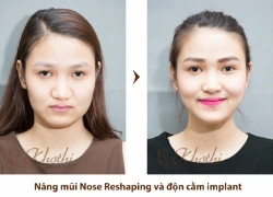 Nâng mũi bằng sụn nhân tạo Hàn Quốc