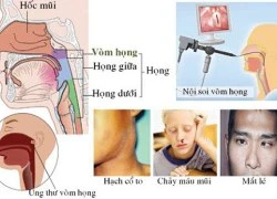 Những dấu hiệu cực nguy hiểm cảnh báo bệnh ung thư vòm họng