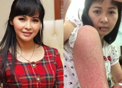 Ca sĩ Trang Nhung bị sốt xuất huyết nghiêm trọng