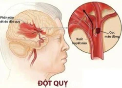 Đột quỵ - bệnh nguy hiểm chết người dễ mắc vào mùa đông