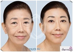 Giảm 60% trẻ hóa da một lần duy nhất với New Thermage