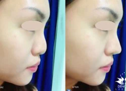 Mũi đẹp tự nhiên sau 5 phút nhờ filler