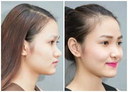 Nâng mũi bằng sụn Nose Reshaping