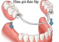 Nên cấy ghép Implant tại bệnh viện