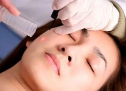 Da "mỏng" có nên làm sáng da bằng laser?