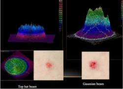 Xóa tàn nhang với laser vi bào