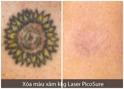 Xóa xăm không để lại sẹo bằng laser PicoSure