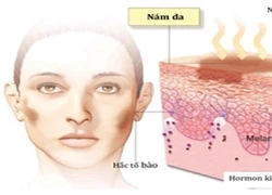 Xua tan vết nám cho làn da trẻ mãi không già