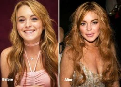 4 chỉnh sửa thẩm mỹ khiến Lindsay Lohan xuống sắc