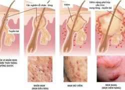 Dùng thuốc trị mụn: Coi chừng đẻ quái thai