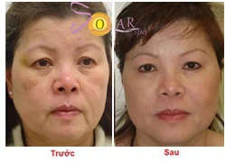 Khuyến mại 50% Thermage CPT đời mới -căng da mặt không phẫu thuật 1 lần duy nhất