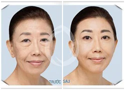 Khuyến mại 60% Thermage phiên bản mới Căng da trẻ hóa 1 lần duy nhất (không phẫu thuật)