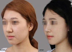 Nâng mũi bằng chất liệu filler