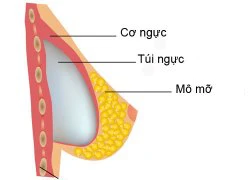 Hai vị trí đặt túi ngực khi cần cải thiện vòng một