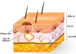 Hiểm họa từ điều trị nám sạm không đúng cách