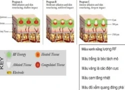 Xóa nhăn và sẹo bằng công nghệ Matrix-RF