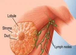 Nhận diện mẫu phụ nữ dễ mắc ung thư vú